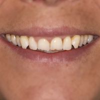 Composite Bonding - Smile 9 before